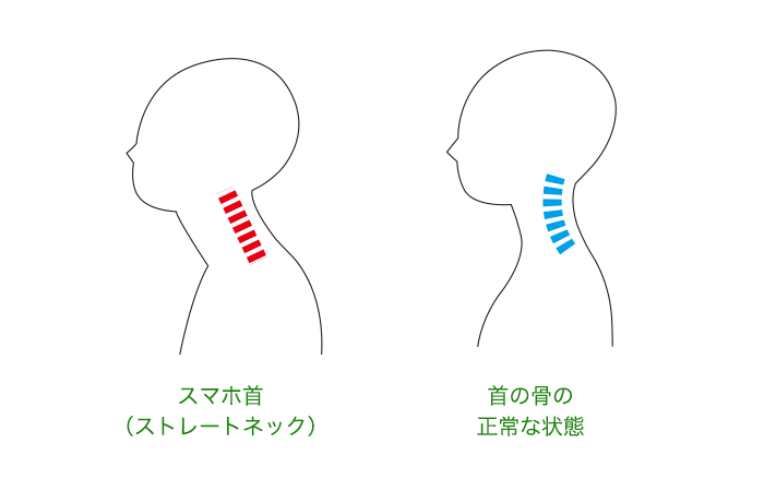 正常な首の状態とスマホ首